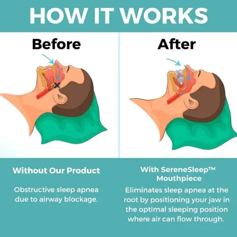 SereneSleep Mouthpiece