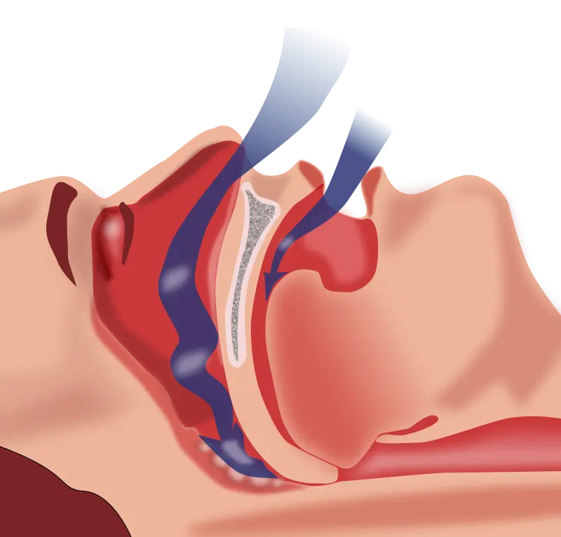 Obstruction Ventilation
