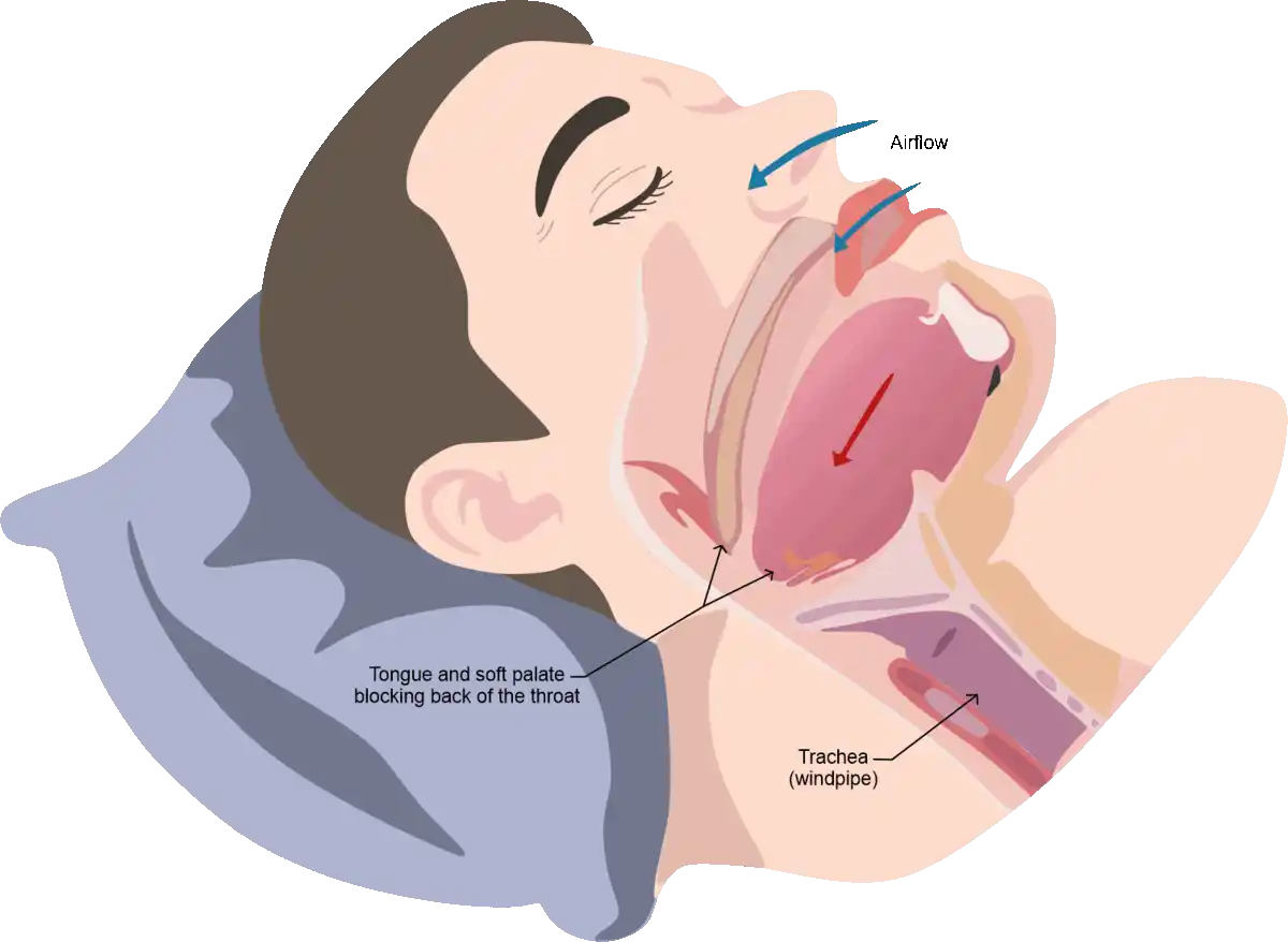 Obstructive Sleep Apnea